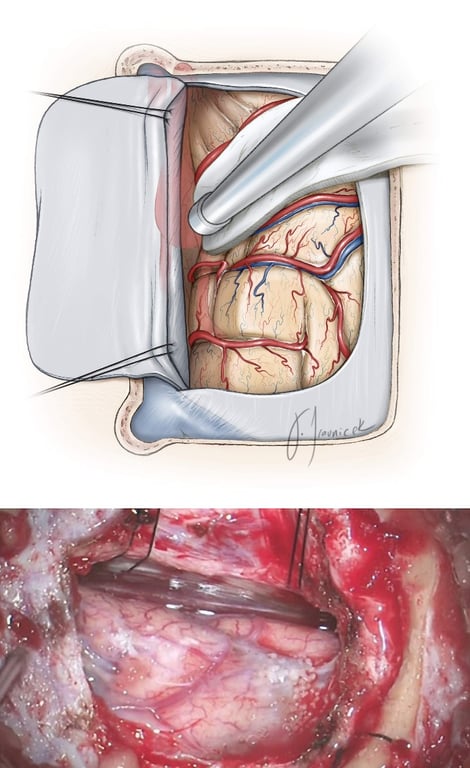 Figure 10: The dura is opened in a U-shaped flap based on the sagittal sinus (top image-supine position). Retraction sutures in the superior falx rotate the venous sinus laterally and expand the interhemispheric reach. Some small bridging veins may be sacrificed, but the larger ones should be preserved. Note that gravity retraction facilitates mobilization of the dependent hemisphere away from the midline (bottom image-lateral position).