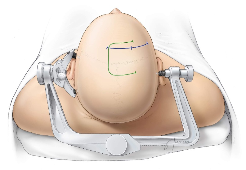 Figure 7: For the anterior interhemispheric approach, the skin incision is made in a curvilinear (blue) or horseshoe (green) fashion behind the hairline. The location of the linear incision is determined by the exact location of the lesion. The horseshoe incision is one-third behind and two-thirds anterior to the coronal suture and crosses the midline. Bone removal over the superior sagittal sinus will allow lateral mobilization of the sinus using retraction sutures in the falx to expand the interhemispheric corridor. For larger tumors, a U-shaped incision is more appropriate. Notice the location of the pins of the skull clamp.