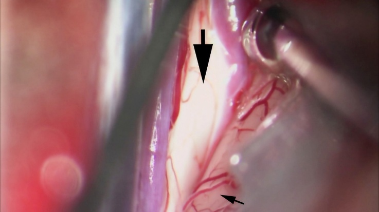 Figure 12: Note the difference in color between the cingulate gyrus (small arrow) and the corpus callosum (large arrow). Very adherent cingulate cortices may be mistaken as corpus callosum. The corpus callosum is glistening white and stands out from the surrounding cortical tissue. Releasing CSF from the lumbar drain will ease this interhemispheric dissection. The operator should watch for the pericallosal arteries and avoid inadvertently injuring them with the tip of the microscissors.