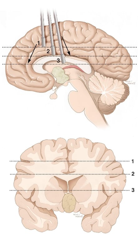 Figure 15: The roadmap through the interhemispheric trajectory toward the midline chambers is demonstrated. Note the sagittal perspective in the above image. It is easy for the surgeon to become disoriented and travel too anteriorly or posteriorly (arrows) along the interhemispheric space. Navigation can keep the surgeon on track. The hashed lines correspond to the landmark levels of dissection in the coronal illustration (bottom image). These levels include the cingulum (1), corpus callosum (2) and fornices (3). If the surgeon is not directing the center of dissection toward the surgical target, additional disruption of normal tissues is later necessary for re-directing the center of dissection.