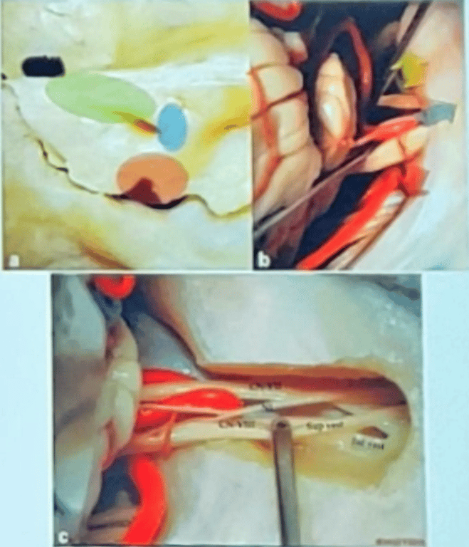 Perimeatal extensions of the retrosigmoid approach. (a,b) The suprameatal extension (green) gives access to Meckel’s cave, while the inframeatal or suprajugular extension (red) exposes the jugular foramen. The transmeatal approach (blue) is helpful in exposing lesions extending into the internal auditory meatus. (c) CN VII, facial nerve; CN VIII, cochleovestibular nerve; Inf vest, inferior vestibular nerve; NI, nervus intermedius; Sup vest, superior vestibular nerve. (Dissections from Professor Albert Rhoton’s laboratory. Courtesy of the Online Rhoton Collection.)
