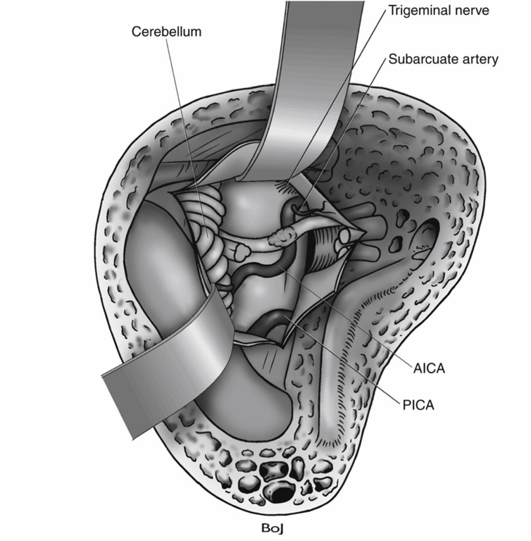 The tumor has been removed. A small tumor remnant is left on the facial nerve. 