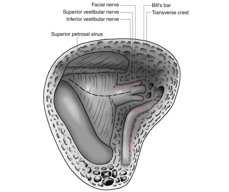 The mastoidectomy has been completed. The internal auditory canal is opened and allows the facial nerve to be identified. The broken lines indicate the dural incisions. 