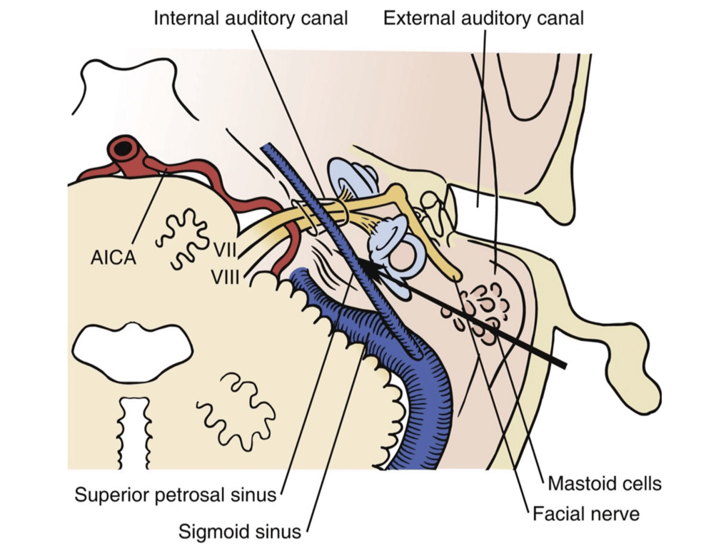 Approach to the cerebellopontine angle through the mastoid and labyrinth. The arrow indicates the surgical view after and extended mastoidectomy. 