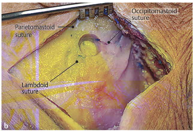 Close-up of a suture AI-generated content may be incorrect.