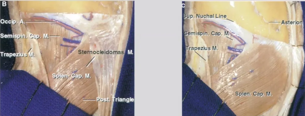 Occ Semi n Muscle splitting approach p. Nuchal Line —Asterio emiépih. Cap. rapezius M. ! Sternocleidomas Splen. Cap. M, riangb 