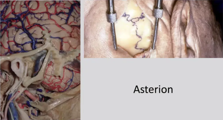 Craniotomy right at the transverse and sigmoid junction