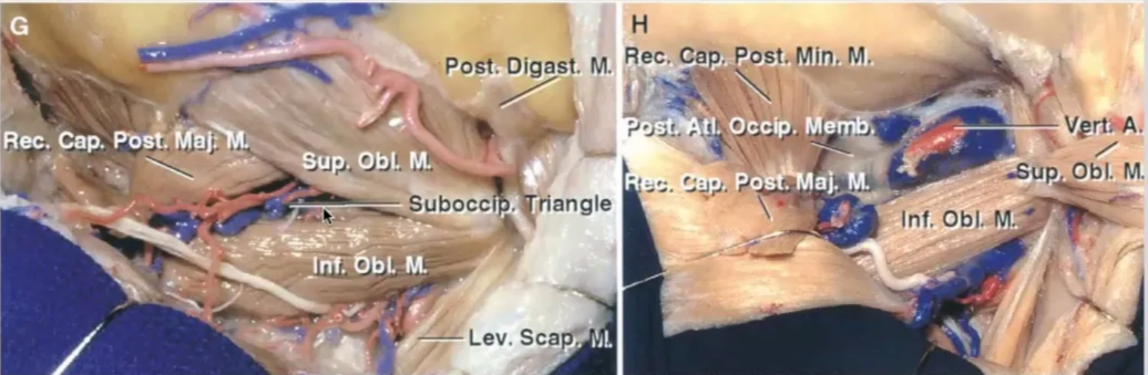Post. Digast. M. Rec. Cpp. Post. Min, M. Rec. cap. u . Obi. M. subocci 6bL riangle VertjA/ -sup Obi. M. Inf. 0b). M. • Lev. Scapl ill. 