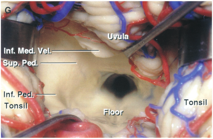•u&la Inf. Meo vel. Inf. Pd. Tonsil Tonsi 
