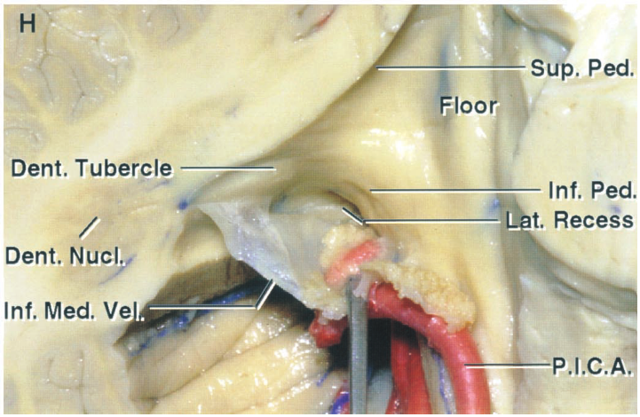 Dent. Tubercle sup, ped. Inf. ped. . Receés Dent. Nucl. p.lC.A Inf. Med. Ve 