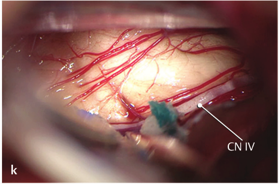 Close-up of blood vessels in the body AI-generated content may be incorrect.