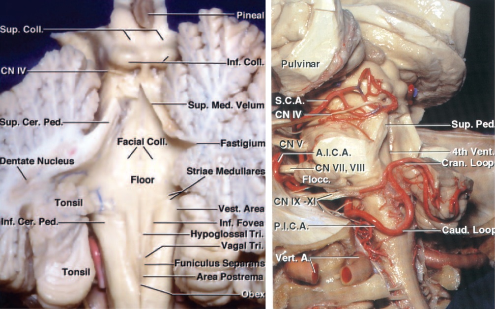 Figure 4: The functional anatomy of the fourth ventricular floor is shown (left image). The route of the superior cerebellar artery (SCA), the anterior inferior cerebellar artery (AICA) and the posterior inferior cerebellar artery (PICA) after removal of the cerebellum is demonstrated (right image—oblique view)(Images courtesy of AL Rhoton, Jr).