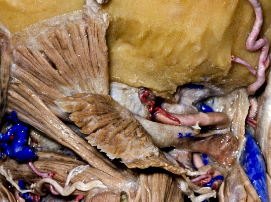 Figure 3: Note the dura is not covered by bone at the level of the craniocervical junction (between the foramen magnum and C1). The vertebral artery segment over the lateral arch of C1 (sulcus arteriosus) is also not covered by bone. The operator should exercise caution while using monopolar electrocautery at the craniocervical junction and avoid penetrating the dura or injuring the artery during muscle dissection. Careful blunt dissection in the region is advised (Image courtesy of AL Rhoton, Jr).