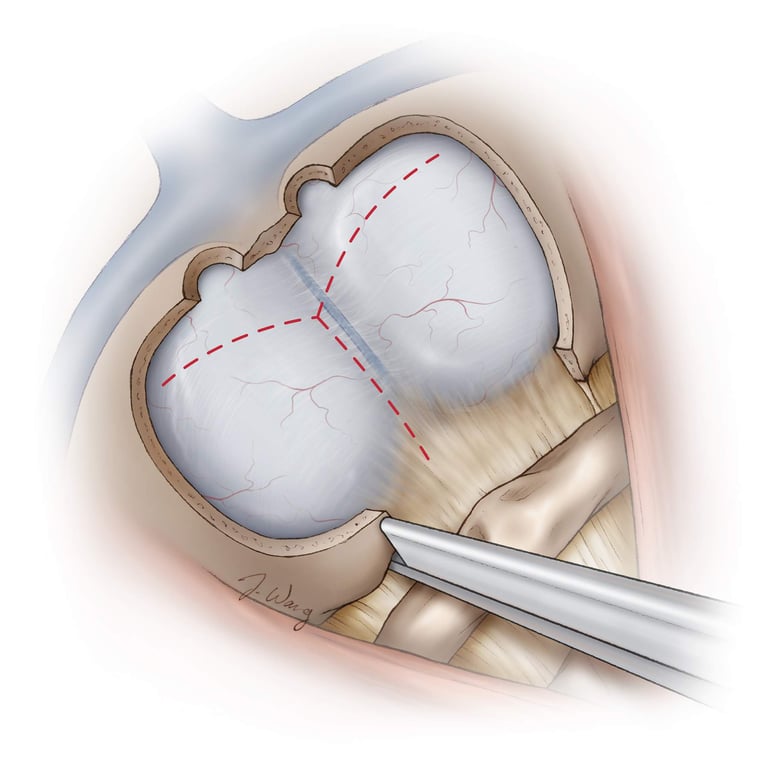 Figure 9: For lesions involving the foramen magnum and upper cervical spine, a C1 laminectomy is performed to allow for a wider dural opening and adequate lesional exposure. Generous removal of the bone along the magnum affords a more flexible inferior-to-superior trajectory to reach fourth ventricular lesions through the telovelar route. The dura is generally opened in a Y-shaped fashion with a more inferior extension for more lateral mobilization of the dural flaps. The superior limb of the dural incision extends to the inferior aspect of the transverse sinus. For midline lesions, the dura may be opened along the midline; this maneuver facilitates watertight dural closure (Redrawn from Tew, van Loveren, Keller*).