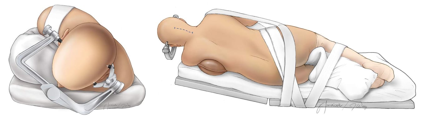 Figure 6: The patient’s head is turned 45 degrees toward the floor and immobilized in a skull clamp. The incision generally extends from the inion to the C2 spinous process. Keen’s point may be prepared if an intraoperative ventriculostomy is contemplated because of hydrocephalus (Redrawn from Tew, van Loveren, Keller*).
