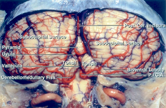 Figure 2: Removal of the suboccipital bone exposes the corresponding dural sinuses. The surface anatomy of the cerebellum is shown (Image courtesy of AL Rhoton, Jr).