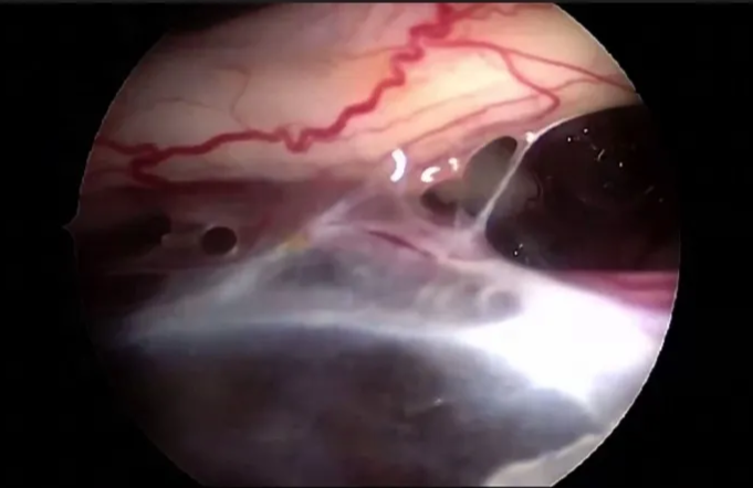 A screenshot of a medical video AI-generated content may be incorrect.