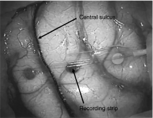 ntral su Recording -strip Fig. I. Grid electrode for recording somatosensory evoked potential phase reversal (SEP-PR). The black line indicates the central sulcus. 