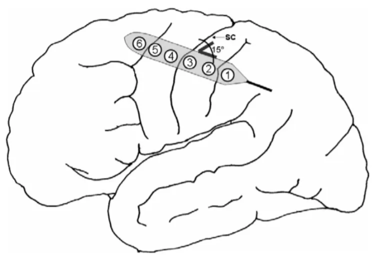 Fig. 2. Diagram showing the correct positioning of the recording grid. Optimal position must have a 150 angle to the central sulcus. 