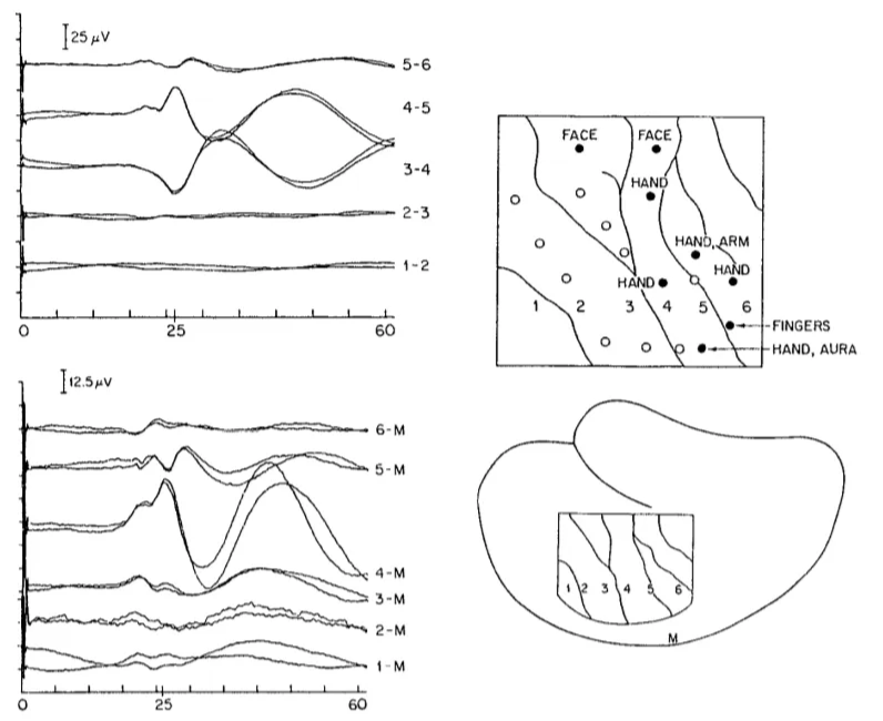 25 ev 12.spv 0 FACE 3-4 2-3 60 FACE 5 6 HAND. 25 60 Fig. 2. SSEP recorded in a bipolar (top left) or referential (bottom left) manner, using a scalp muscle reference (M). The orientation of electrodes is shown (bottom right), as it would be seen by the surgical team. The more detailed diagram of electrode locations (top right) allows one to compare locations where direct cortical stimulation produced sensations (closed circles). This patient was conscious during the operation. In one location, direct cor- tical stimulation also produced the patient's typical epileptic aura. At other locations, no sensation was caused by direct cortical stimulation (open circles). Higher intensity stimula- tion probably would have caused motor responses from some of the anterior locations tested. At 25 ms an N20 negative potential was seen maximally around electrode 4. Just prior to that, at about 22 ms, a series of small negative potentials was seen, also maximal around electrode 4. 'Ihese results confirm that electrode 4 lay in the primary sensory cortex, allow- ing us to deduce that electrodes 2 and 3 lay on the motor cortex. (From Nuwer 1987) 