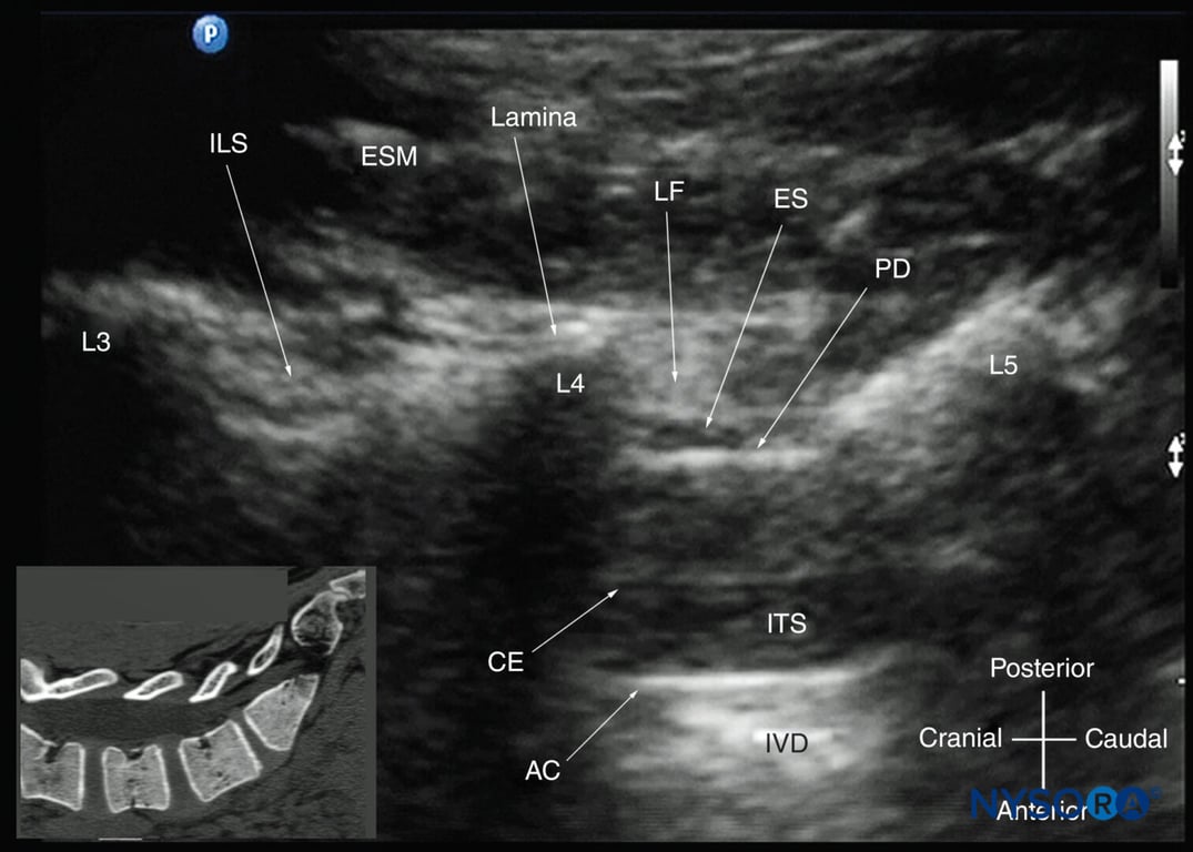 Paramedian sagittal oblique sonogram of the lumbar spine at the level of the lamina showing the L3–4 and L4–5 interlaminar spaces. Note the hypoechoic epidural space (a few millimeters wide) between the hyperechoic ligamentum flavum and the posterior dura. The intrathecal space is the anechoic space between the posterior dura and the anterior complex. The cauda equina nerve fibers are also seen as hyperechoic longitudinal structures within the thecal sac. The hyperechoic reflections seen in front of the anterior complex are from the intervertebral disc (IVD). The inset image shows a matching computed tomography (CT) scan of the lumbosacral spine in the same anatomical plane as the US scan. The CT slice was reconstructed from a three-dimensional CT dataset from the author’s archive. AC, anterior complex; CE, cauda equina; ES, epidural space; ESM, erector spinae muscle; ILS, interlaminar space; ITS, intrathecal space; IVD, intervertebral disc; L3, lamina of L3 vertebra; L4, lamina of L4 vertebra; L5, lamina of L5 vertebra; LF, ligamentum flavum; PD, posterior dura.