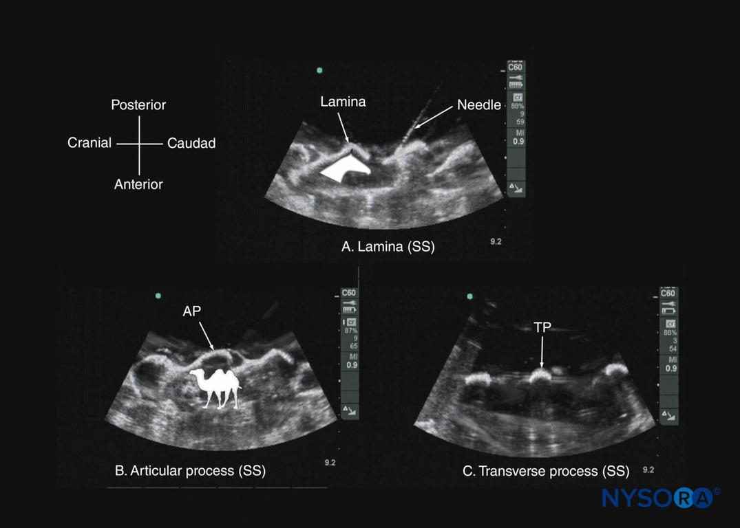 Paramedian sagittal sonogram of the (A) lamina; (B) articular process; and (C) transverse process from a water-based spine phantom. Note the needle in contact with the lamina in (a), a method that was used to validate the sonographic appearance of the osseous elements in the phantom. The inset image in (a) illustrates the horse-head–like appearance of the laminae, and the inset image in (b) illustrates the camel-hump–like appearance of the articular processes. AP, articular process; SS, sagittal scan; TP, transverse process.