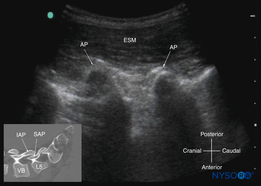Paramedian sagittal sonogram of the lumbar spine at the level of the articular processes (APs) of the vertebrae. Note the “camel hump” appearance of the APs. The inset image shows a corresponding computed tomography (CT) scan of the lumbosacral spine at the level of the APs. The CT slice was reconstructed from a three-dimensional CT dataset from the author’s archive. ESM, erector spinae muscle; IAP, inferior articular process; SAP, superior articular process; VB, vertebral body