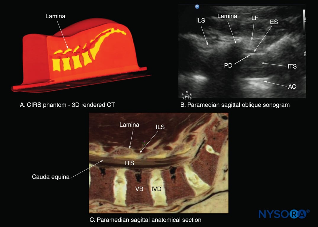 Paramedian sagittal sections of the lumbosacral spine showing the lamina, interlaminar spaces, and spinal canal.(A)Three- dimensional (3D) reconstruction of high-resolution computed tomography (CT) scan dataset from the CIRS phantom. (B) Paramedian sagittal oblique sonogram through the L3–5 interlaminar spaces. (C) Paramedian sagittal cadaver anatomic section. AC, anterior complex; ES, epidural space; ILS, interlaminar space; ITS, intrathecal space; IVD, intervertebral disc; LF, ligamentum flavum; PD, posterior dura; VB, vertebral body.
