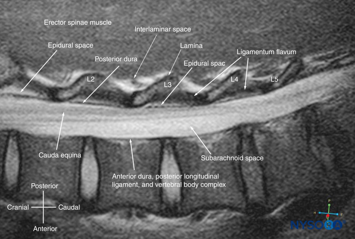 Paramedian sagittal MRI section of the lumbar spine at the level of the lamina.