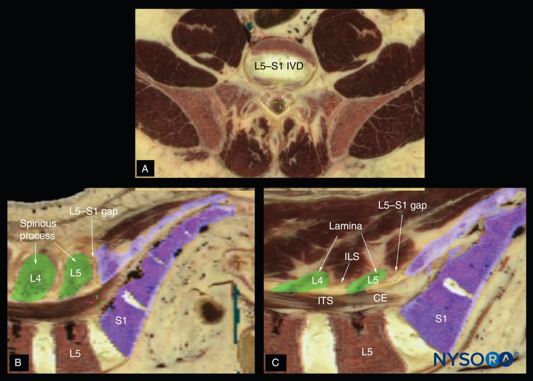 Cadaver anatomical section showing the lumbosacral junction (L5–S1 gap) in the (A) transverse axis; (B) median (sagittal) axis and (C) paramedian sagittal axis. CE, cauda equina; ILS, interlaminar space; ITS, intrathecal space; IVD, intervertebral disc.