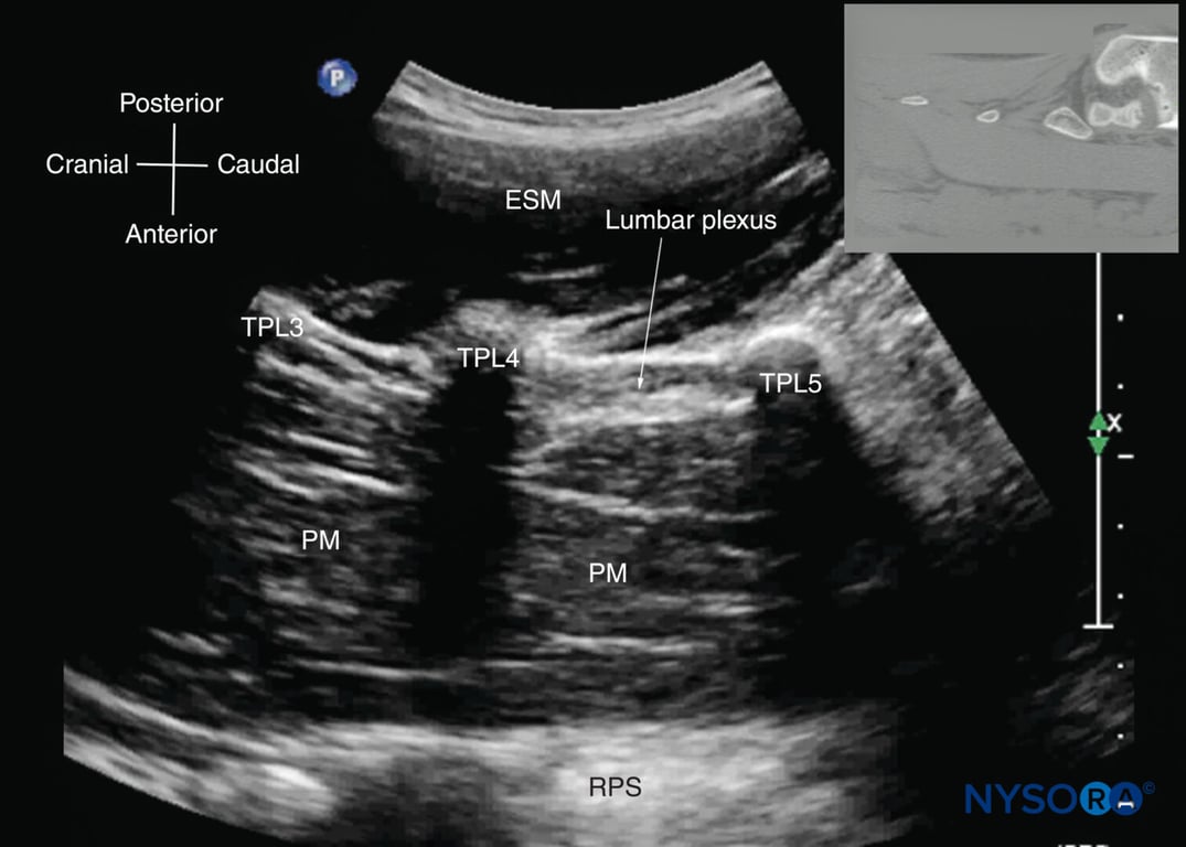 Paramedian sagittal sonogram of the lumbar spine at the level of the transverse processes (TPs). Note the hyperechoic reflections of the TPs with their acoustic shadow that produces the “trident sign.” The psoas muscle (PM) is seen in the acoustic window between the transverse processes and is recognized by its typical hypoechoic and striated appearance. Part of the lumbar plexus is also seen as a hyperechoic shadow in the posterior part of the psoas muscle between the transverse processes of the L4 and L5 vertebrae. The inset image shows a corresponding computed tomography (CT) scan of the lumbosacral spine at the level of the TPs. The CT slice was reconstructed from a three-dimensional CT dataset from the author’s archive. ESM, erector spinae muscle; RPS, retroperitoneal space.