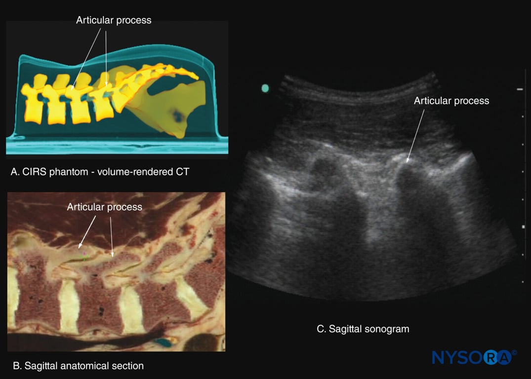Paramedian sagittal sections of the lumbar spine at the level of the articular processes (APs). (A) Three-dimensional reconstruction of a high-resolution computed tomography (CT) scan dataset from the CIRS phantom. (B) Paramedian sagittal cadaver anatomical section. (C) Paramedian sagittal sonogram.