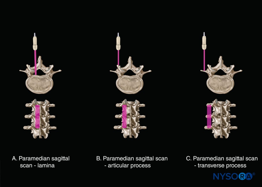 Axis of scan: paramedian sagittal scan (A) at the level of the lamina; (B) at the level of the articular process; and (C) at the level of the transverse process.