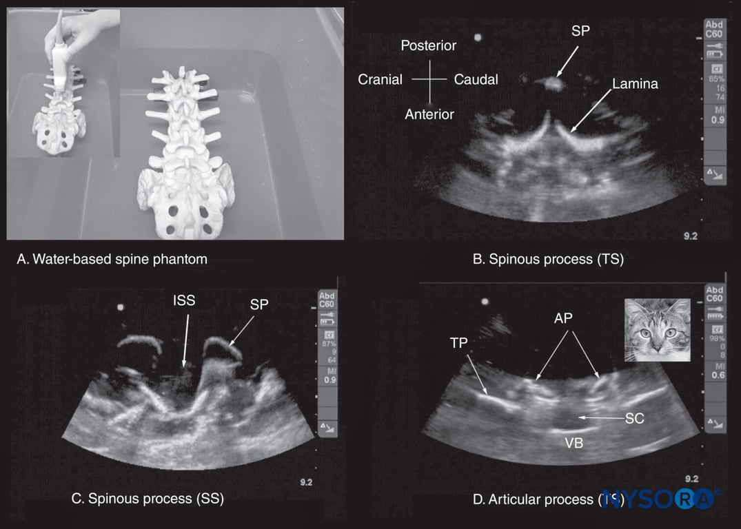 (A) The water-based spine phantom. The lumbosacral spine is immersed in a water bath and imaged through the water using a curved linear transducer. The other images are sonograms from the water-based lumbosacral spine phantom showing (B) the transverse spinous process (SP) view; (C) the median sagittal spinous process view; and (D) the transverse interspinous view. An inset image has been placed next to figure (d) to illustrate the resemblance of the sonographic appearance of the transverse interspinous view to a cat’s head; hence, this is referred to as the “cat’s head sign.” AP, articular process; ISS, interspinous space; SC, spinal canal; SP, spinous process; SS, sagittal scan; TP, transverse process; TS, transverse scan; VB, vertebral body.