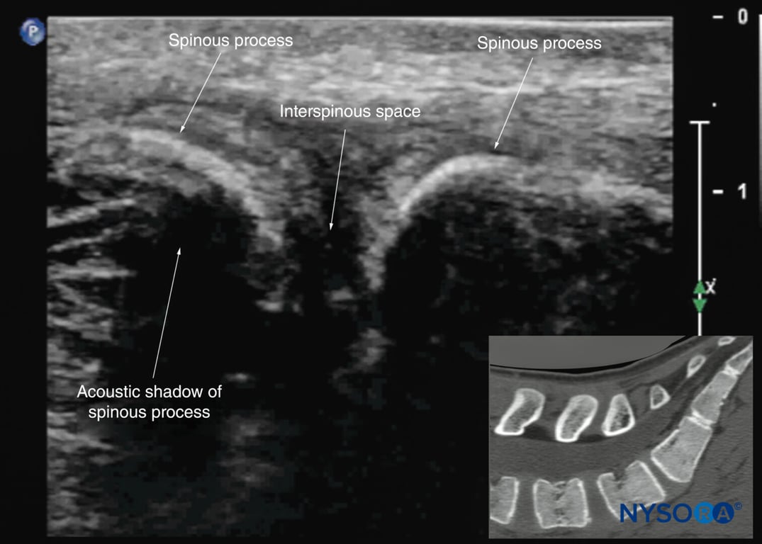 Median sagittal sonogram of the lumbar spine showing the crescent-shaped hyperechoic reflections of the spinous processes. Note the narrow interspinous space in the midline. The inset image shows a corresponding computed tomography (CT) scan of the lumbosacral spine through the median plane. The CT slice was reconstructed from a three-dimensional CT dataset from the author’s archive.