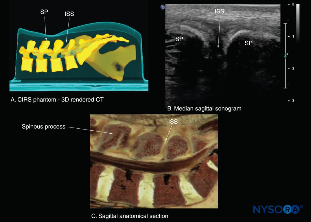Median sagittal sections of the lumbosacral spine. (A) Three-dimensional (3D) reconstruction of high-resolution computed tomography (CT) scan dataset from the CIRS phantom. (B) Median sagittal sonogram showing the spinous process (SP) and interspinous space (ISS). (C) Median sagittal cadaver anatomical section.