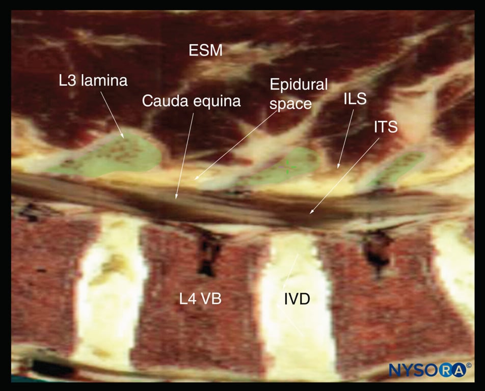 Sagittal cadaver anatomical section of the lumbar spine through the lamina of the lumbar spine, rendered from the Visible Human Server male dataset. ESM, erector spinae muscle; ILS, interlaminar space; ITS, intrathecal space; IVD, intervertebral disc; VB, vertebral body.