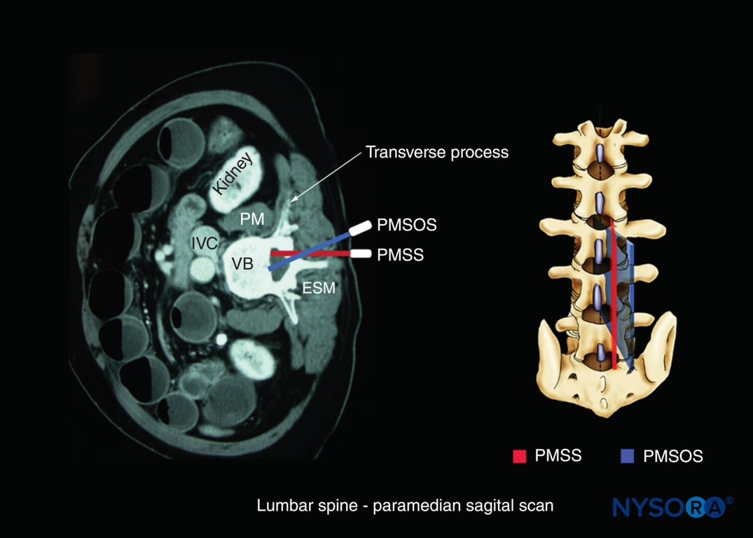 Axis of scan: paramedian sagittal oblique scan of the lumbar spine. Note the medial direction of the US beam (blue). ESM, erector spinae muscle; IVC, inferior vena cava; PM, psoas major muscle; PMSOS, paramedian sagittal oblique scan; PMSS, paramedian sagittal scan (red); VB, vertebral body.