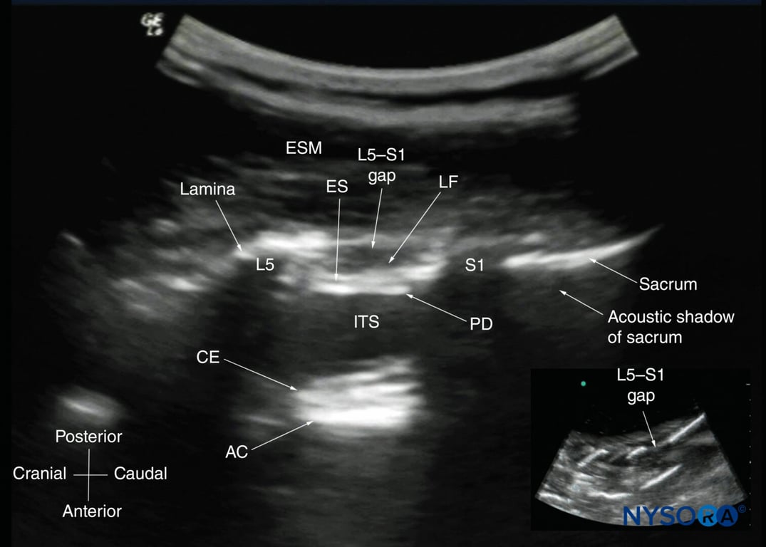 Paramedian sagittal sonogram of the lumbosacral junction. The posterior surface of the sacrum is identified as a flat hyperechoic structure with a large acoustic shadow anteriorly. The dip or gap between the sacrum and the lamina of L5 is the L5–S1 intervertebral space, or the L5–S1 gap. The inset image is a matching sonogram from a water-based spine phantom showing the L5–S1 gap. AC, anterior complex; CE, cauda equina; ES, epidural space; ESM, erector spinae muscle; ITS, intrathecal space; LF, ligamentum flavum; PD, posterior dura.