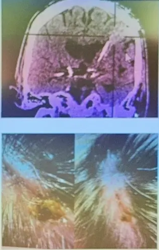 What is Deep Brain Stimulation? Risks: 1 %: Intracranial bleeding (< 1% symptomatic bleeding) 2-5 % Infection or technical malfunction Benefits: 70 - 80% Improvement 