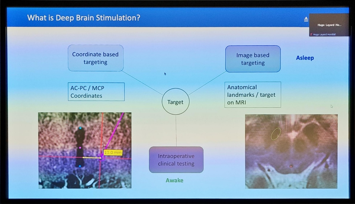 What is Deep Brain Stimulation? Coordinate based targeting AC-PC / MCP Coordinates Target 11.0 mm Intraoperative clinical testing Awake Hgo Hugo L*yard Horsfan Asleep Image based targeting Anatomical landmarks / target on MRI 
