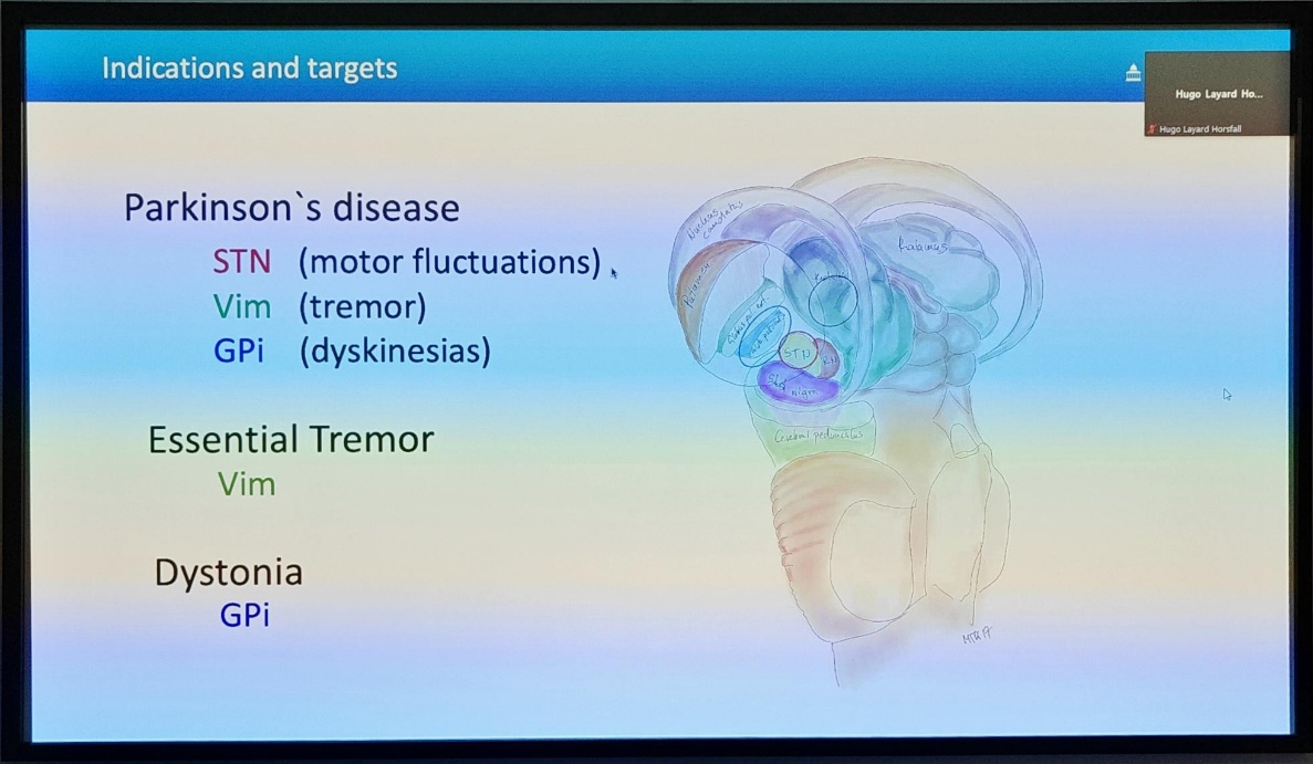 Indications and targets Parkinsoms disease STN (motor fluctuations) Vim (tremor) GPi (dyskinesias) Essential Tremor Vim Dystonia GPi Hugo Layud Haw Hugo Layard Horsfa" 