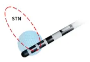 To Explore Another Tract Or Not . Easy • Poor cells/short tract • No effect on symptoms • Side effect at low current • Trickier • Reasonable cells/tract length • Some effect on symptoms • Side effects at higher current Risk v Benefit Intrusiveness of side effects Mitigation by Steerable multiple contacts DBS 