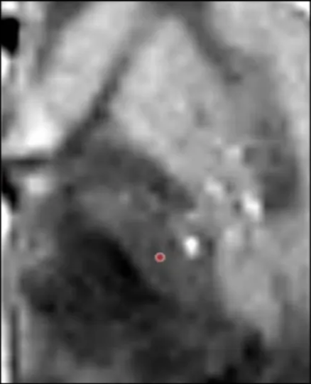 TARGETING - DYSTONIA 