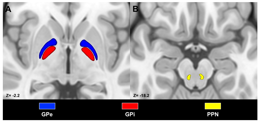 Anatomical Characterization of the Human Structural Connectivity between the Pedunculopontine Nucleus and Globus Pallidus via Multi-Shell Multi-Tissue Tractography