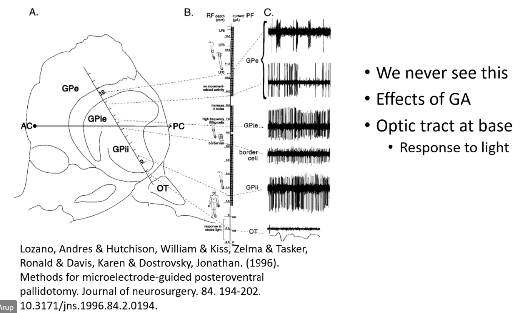 B. GPO GPie Lozano, Andres & Hutchison, William & Kiss, Zelma & Tasker, Ronald & Davis, Karen & Dostrovsky, Jonathan. (1996). Methods for microelectrode-guided posteroventral pallidotomy. Journal of neurosurgery. 84. 194-202. 10.3171/jns.1996.84.2.0194. • We never see this • Effects of GA • Optic tract at base • Response to light 