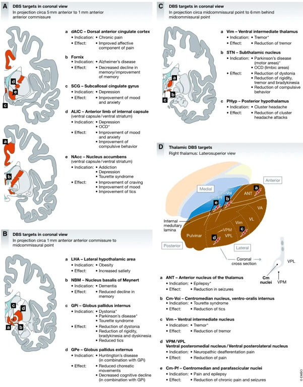 EMBO Molecular Medicine DBS targets in coronal view In projection circa 5 mm anterior to 1 mm anterior C Mechanisms Of deep brain stimulation DBS targets in coronal view Martin Jakobs et al In projection circa midcommissural point to 6mm behind anterior commissure a b c d e DBS targets in coronal view dACC — Dorsal anterior cingulate cortex • Indication: • Chronic pain • Effect: • Improved affective component of pain Fornix • Indication: • Alzheimer's disease • Effect: • Decreased decline in memory/ improvement of memory SCG — Subcallosal cingulate gyrus • Indication: • Depression • Effect: • Improvement of mood and anxiety ALIC — Anterior limb of internal capsule (ventral capsule/ventral striatum) • Indication: • Depression • OCD• • Effect: • Improvement of mood and anxiety • Improvement of compulsive behavior NACC — Nucleus accumbens (ventral capsule/ ventral striatum) • Indication: • Addiction midcommissural point Thalamic DBS targets a b c Vim — Ventral intermediate thalamus • Indication: • Tremor* • Reduction of tremor STN — Subthalamic nucleus • Indication: • Parkinson's disease • Effect: (motor areas) • • OCD (limbic areas) • Reduction of dystonia • Reduction of rigidity, tremor and bradykinesia • Reduction of compulsive behavior PHyp — Posterior hypothalamus • Indication: • Cluster headache • Effect: • Reduction of cluster headache attacks Right thalamus: Laterosuperior view Medial Anterior • Effect: • Depression • Tourette syndrome • Improvement of craving • Improvement of mood • Improvement of tics ANT VL Pulvinar In projection circa 1 mm anterior anterior commissure to midcommissural point Internal medullary lamina Posterior LHA — Lateral hypothalamic area • Indication: • Obesity Vim FVPM Lateral — Coronal cross section a b c d • Effect: • Increased satiety cm nuclei VPL VPM NBM — Nucleus basalis of Meynert • Indication: • Dementia • Effect: • Reduced decline in memory GPi — Globus pallidus internus • Indication: • Dystonia• a b c d e ANT — Anterior nucleus of the thalamus • Indication: • Epilepsy' • Effect: • Reduction in seizures • Effect: • Parkinson's disease' • Tourette syndrome • Reduction of dystonia • Reduction of rigidity, bradykinesia and dyskinesia • Reduced tics Gpe — Globus pallidus extemus • Indication: • Huntington's disease (in combination with GPi) • Reduced choreatic movements • Decreased cognitive decline (in combination with GPi) Figure 7. • Effect: Overview Of selected targets for DBS. Cm-Voi — Centromedian nucleus, ventro-oralis internus • Indication: • Tourette syndrome • Effect: • Reduction of tics Vim — Ventral intermediate nucleus • Indication: • Tremor* • Effect: • Reduction of tremor VPM/VPL Ventral posteromedial nucleus/ Ventral posterolateral nucleus • Indication: • Neuropathic deafferentation pain • Effect: • Reduction of pain Cm-Pf — Centromedian and parafascicular nuclei • Indication: • Pain and epilepsy • Effect: • Reduction of chronic pain and seizures Location Of DBS targets for established and investigational indications: (A) DBS targets in coronal projection view (rostra' to anterior commlssure), (B) DBS targets in coronal projection view (anterior commissure to midcommissural point), (C) midcommissural point to posterior commissure), and (D) overview of thalamic DBS targets. 12 of 18 EMBO Molecular Medicine | 2019 0 2019 The Authors 