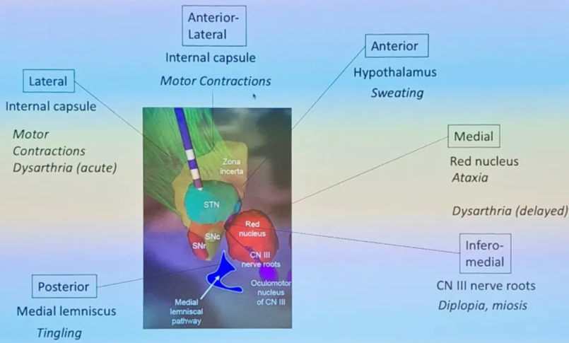 STN DBS for Parkinson Disease Lateral Internal capsule Motor Contractions Dysarthria (acute) Posterior Medial lemniscus Tingling Anterior- Lateral Internal capsule Motor Contractions Zona incerta; STN SNC SN Medial lemniscal pathway Red nucleus CN Ill nerve roots Oculomotor nucleus of CN Ill Hugo Layard Hugo Layard Anterior Hypothalamus Sweating Medial Red nucleus Ataxia Dysarthria (delayed) Infero- medial CN Ill nerve roots Diplopia, miosis 