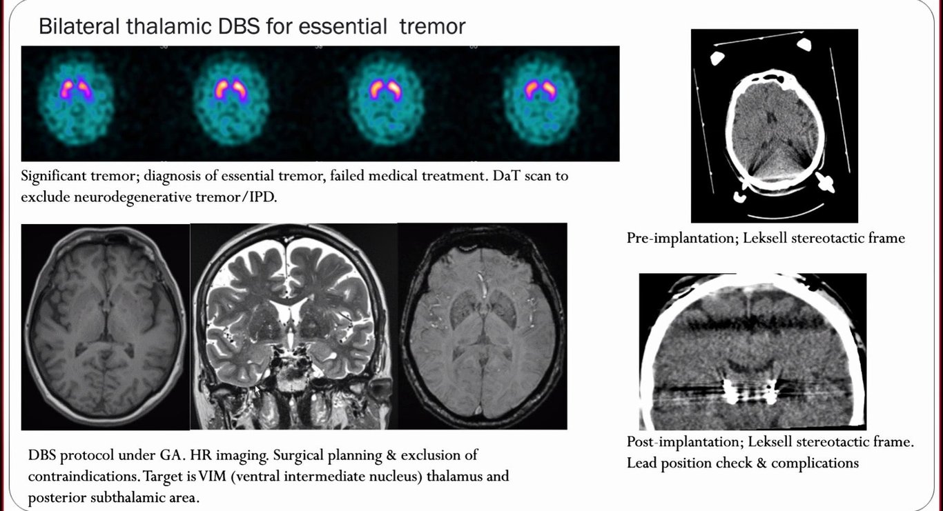 Bilateral thalamic DBS for essential tremor Significant tremor; diagnosis of essential tremor, failed medical treatment. DaT scan to exclude neurodegenerative tremor/ IPD. DBS protocol under GA. HR imaging. Surgical planning & exclusion of contraindications. Target is VIM (ventral intermediate nucleus) thalamus and posterior subthalamic area. Pre-implantation; Leksell stereotactic frame Post-implantation; Leksell stereotactic frame. Lead position check & complications 