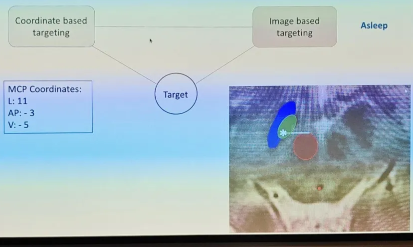 STN DBS for Parkinson Disease Coordinate based targeting MCP Coordinates: L: 11 Image based targeting Layud Hugo Asleep Target 